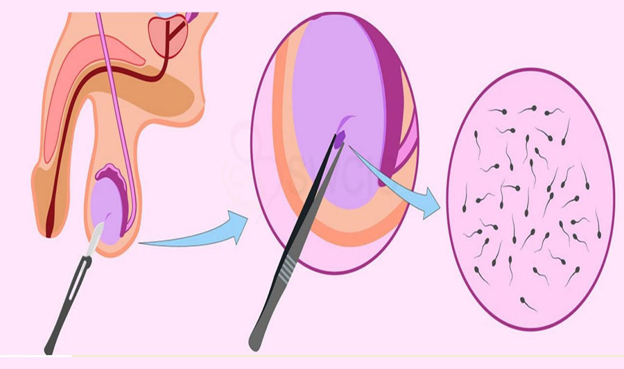 PESA and TESA Procedures at Miracle IVF Hospital, Bangalore.